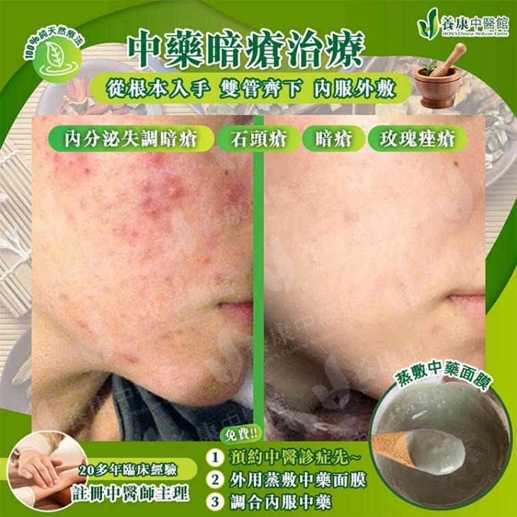 養康中醫館中藥暗瘡治療對比：內分泌失調暗瘡與調理後皮膚，以及蒸敷中藥面膜